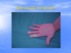 Raynaudův fenomén 1 p32a.zoom15